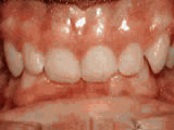 Deep overbite - Lower front teeth bite into palate before