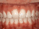 Overjet - Protruding front teeth after