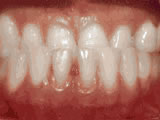 Underbite - Lower front teeth in front of upper teeth before